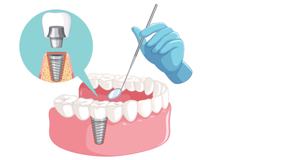 Дентальная имплантация зубов